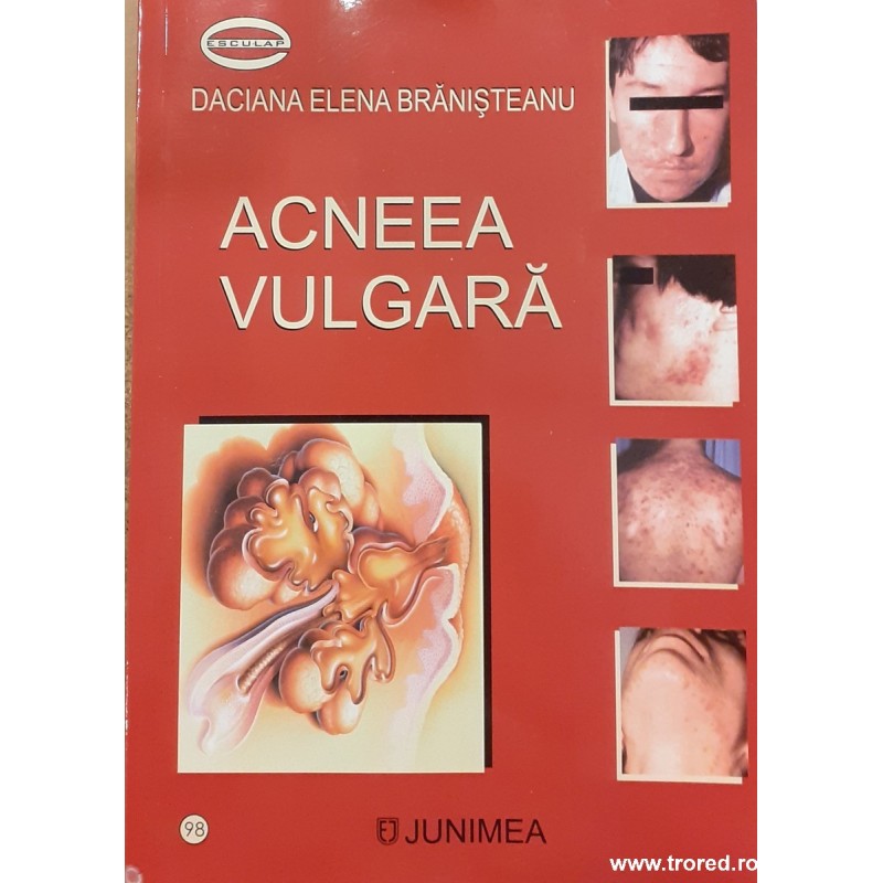Acneeea vulgara